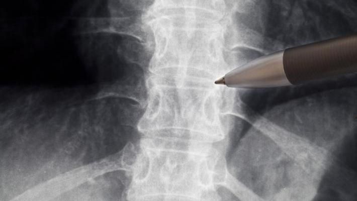 Spine x-ray being pointed at