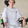 Blake Haxton in 2009, after surviving a near-fatal bout with necrotizing faciitis. (Courtesy of The Columbus Dispatch)